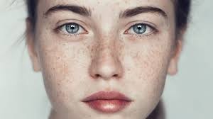 how to get rid of freckles 15 top