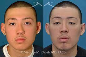 Deviated septum may require surgery. New York Septoplasty Deviated Septum Repair Maurice M Khosh Md Facs