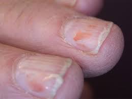 split nails pictures causes and