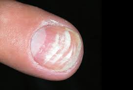 pictures of nail diseases and problems