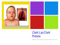 ppt cleft lip cleft palate powerpoint
