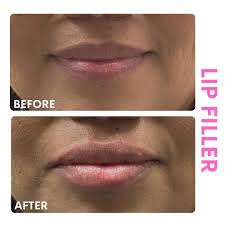 lip filler injections beautox bar