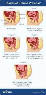 what is pelvic organ prolapse