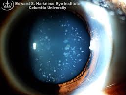 Blue Dot Cataract Columbia Ophthalmology