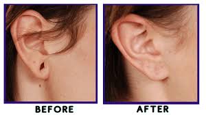 an earlobe reconstruction surgery