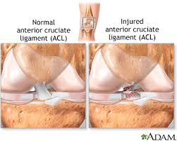 anterior cruciate ligament acl injury