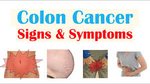 colon cancer crc signs symptoms