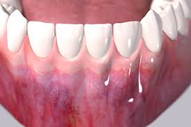 palate free treatment for gum recession