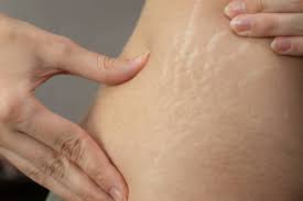 how to remove stretch marks 10 top