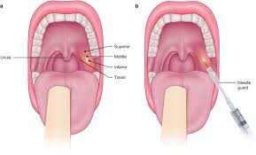 drainage of peritonsillar abscess