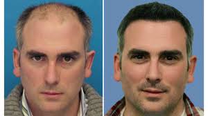 incredible hair transplant surgery