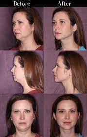 face contouring for younger patients