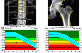 bone mineral density spine ap t score