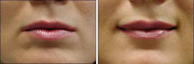 lip enhancement chicago surgery