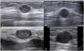 They may also feel firm or solid, and might simple imaging techniques, such as a mammogram or breast ultrasound, can usually provide reassurance. Triple Negative Invasive Breast Carcinoma The Association Between The Sonographic Appearances With Clinicopathological Feature Scientific Reports