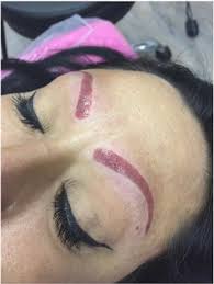 eyebrow tattoo microblading removal