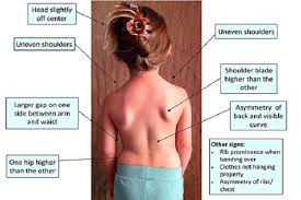 curve in your child s spine normal