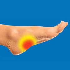 The arches of the foot, formed by the tarsal and metatarsal bones, strengthened by ligaments and tendons, allow the foot to support the weight of the body in the erect posture with the least weight. High Arches Pes Cavus Relieve Foot Pain Leg Pain
