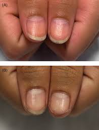 a bilateral thumbnails after treatment