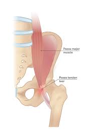 hip pain after running causes pain