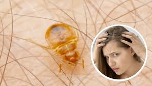 Bed Bugs In Hair Simple Instruction