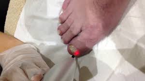 fungal nail treatment with cal