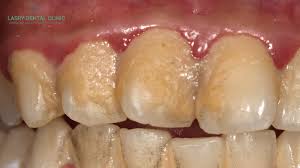 remove plaque buildup on teeth