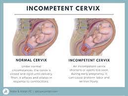 incompetent cervix signs symptoms