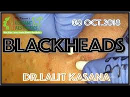 She adds there are multiple causes of blackheads, and for most people, it depends on a number of factors. Blackhead Removal Anti Acne Therapy By Dr Lalit Kasana 08oct 2018 Youtube
