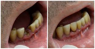 In cases of simple extraction of tooth, the socket is packed with a gauze pad. Tooth Extraction Nyc Manhattan Tooth Extraction 209 Nyc Dental