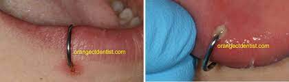 infected lip ring piercing infections