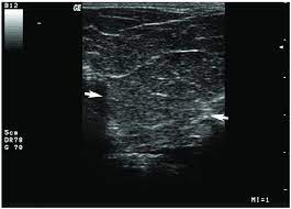 ultrasound image of perineal lipoma an