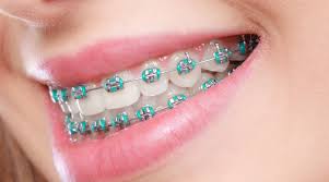 Metal braces Im Orthodontics