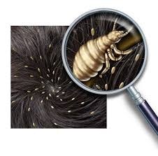 head lice symptoms lice clinics