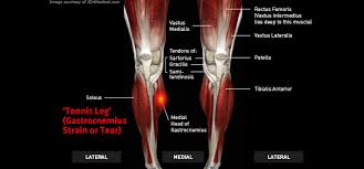 Is there anyway to help loosen this tendon other than heat and massage? Tennis Leg Gastrocnemius Strain Or Tear Thermoskin Supports And Braces For Injury And Pain Management