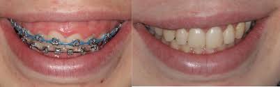 gums growing over braces nemeth