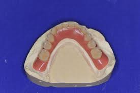 8 are dentures covered by private health insurance? Patient Aus Der Region Eckernforde Erhalt Neue Implantatgestutzte Cover Denture Prothesen Cmd Patientenratgeber