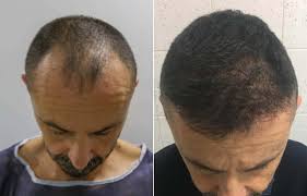 before and after hair transplant step