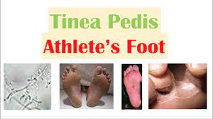 athlete s foot during pregnancy causes