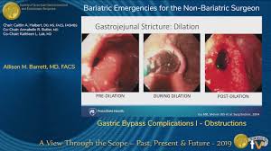 gastric byp complications i