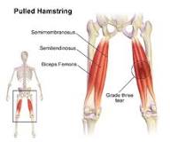 Image result for icd code for hamstring strain