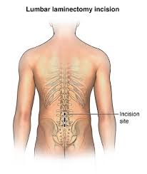 Check out our human back bone selection for the very best in unique or custom, handmade pieces from our shops. Laminectomy Johns Hopkins Medicine