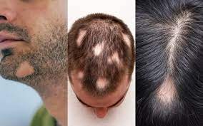 alopecia areata circular or patchy