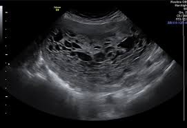focal uterine lesions radiology key