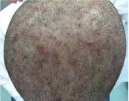 scalp folliculitis according to the nhs