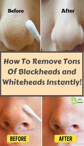 How to remove whiteheads on nose or face permanently. Pin On Home Remedies