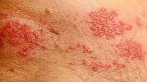 8 common types of rashes