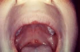 canker sores harmless mouth ulcers