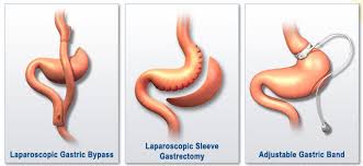 why is it the leading bariatric surgery