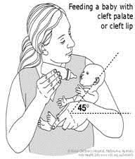cleft lip and palate in neonates